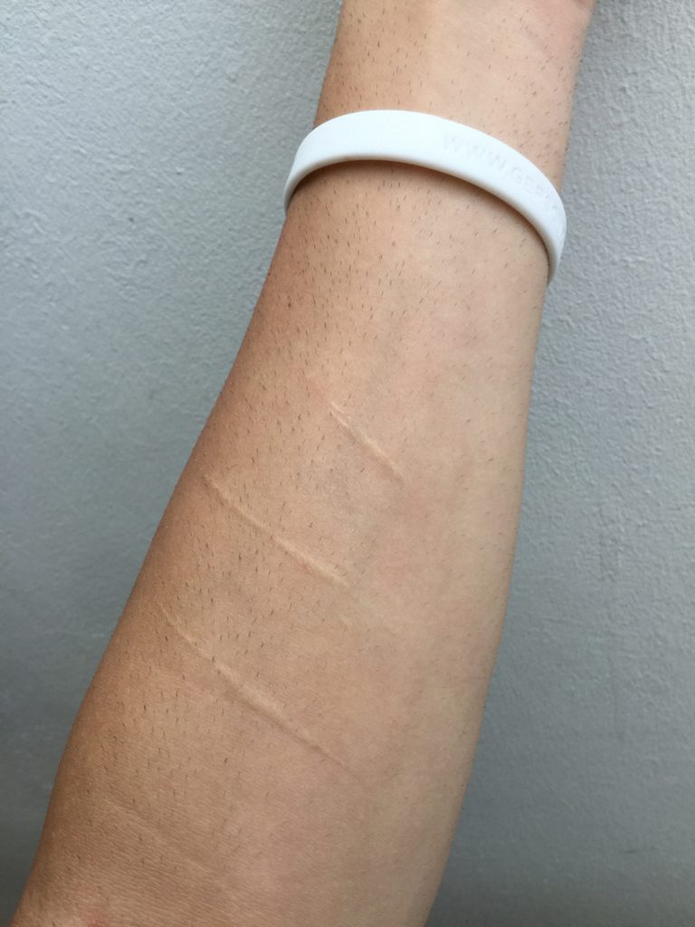Scars.